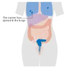 Stage 4B cervical cancer